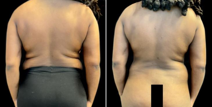 Back Lipo Results Atlanta