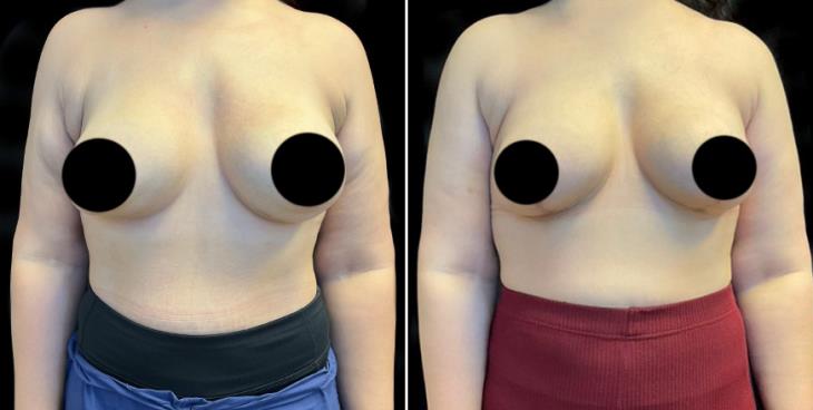 Mastopexy Surgery Results