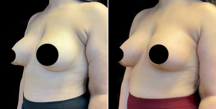 Results Of Mastopexy Surgery