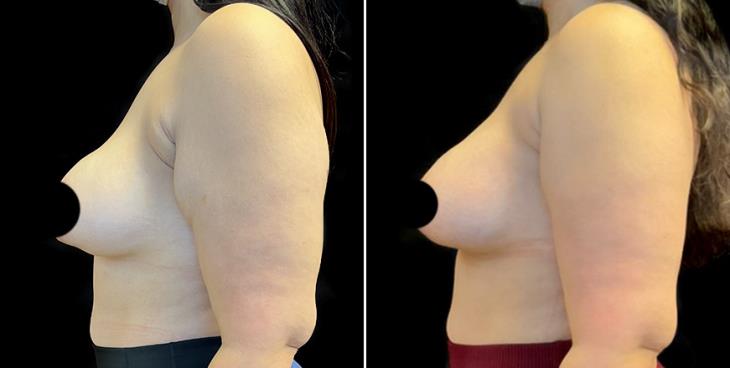 Atlanta Mastopexy Surgery Results