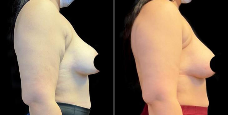 Results Of Mastopexy Surgery In Atlanta