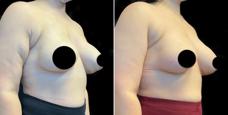 Mastopexy Surgery Results Atlanta