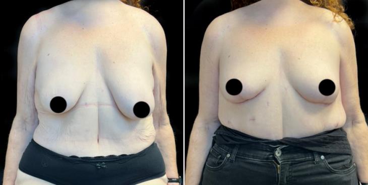 Mastopexy Surgery Results Atlanta GA