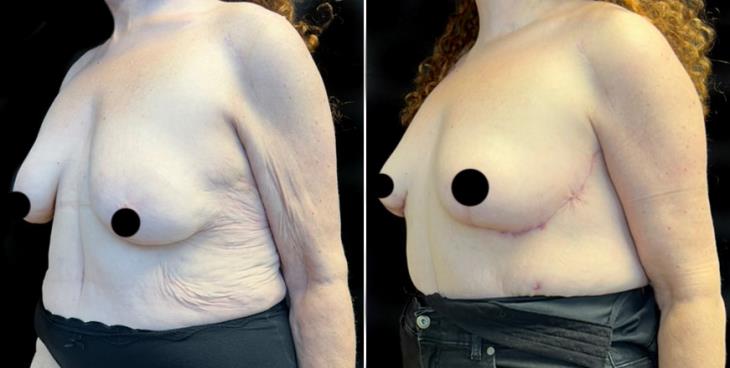 Atlanta GA Mastopexy Surgery Results