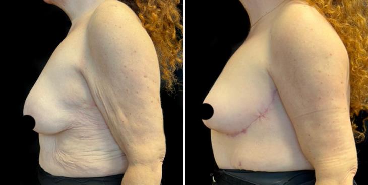 Atlanta Georgia Mastopexy Surgery Results