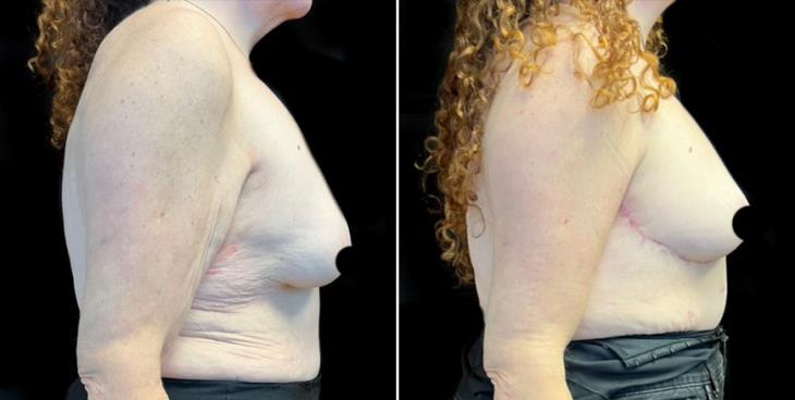 Mastopexy Surgery Results Cumming Georgia