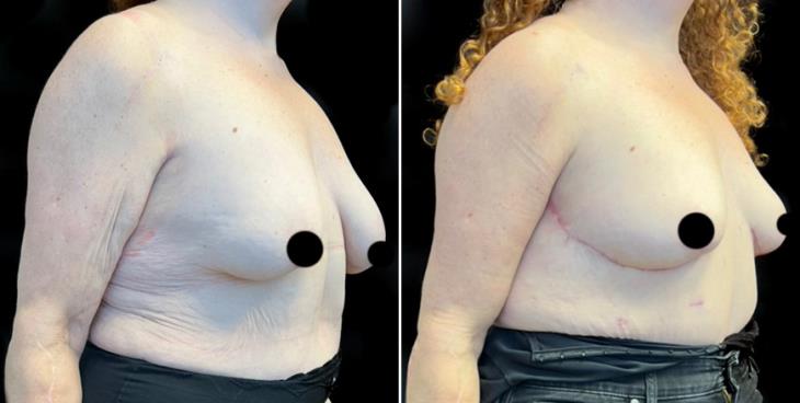 Mastopexy Surgery Results Atlanta Georgia