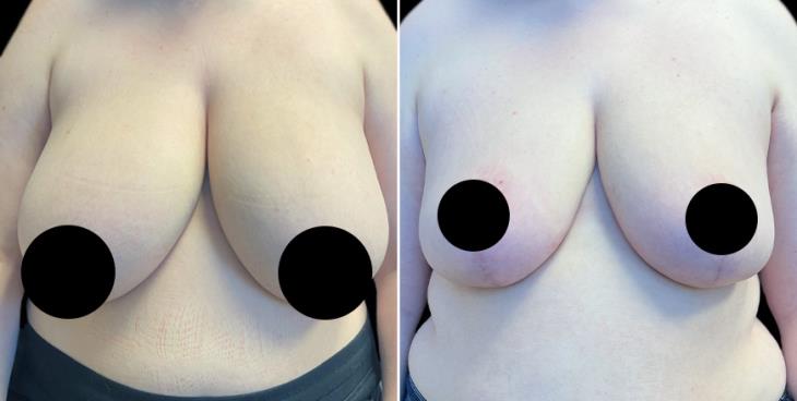 Reduced Breasts Atlanta