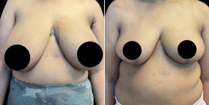 Atlanta Georgia Reduced Breasts