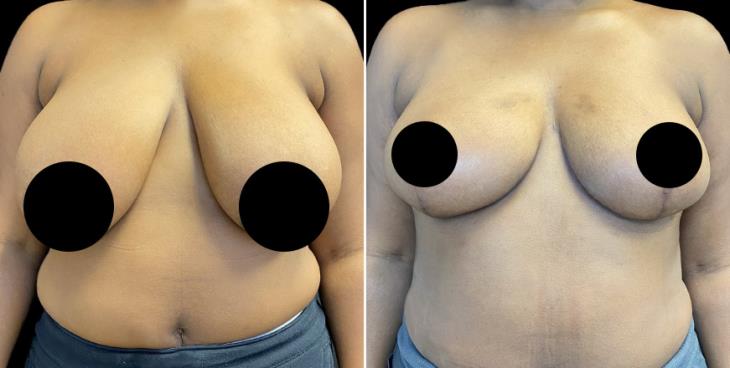 Reduced Breasts Marietta