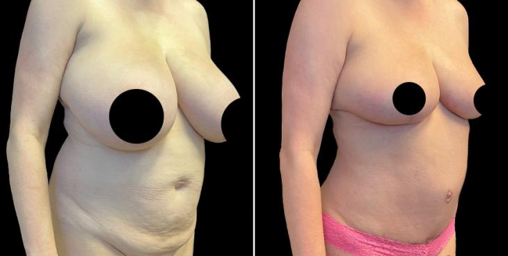 Atlanta ¾ View Reduced Breasts