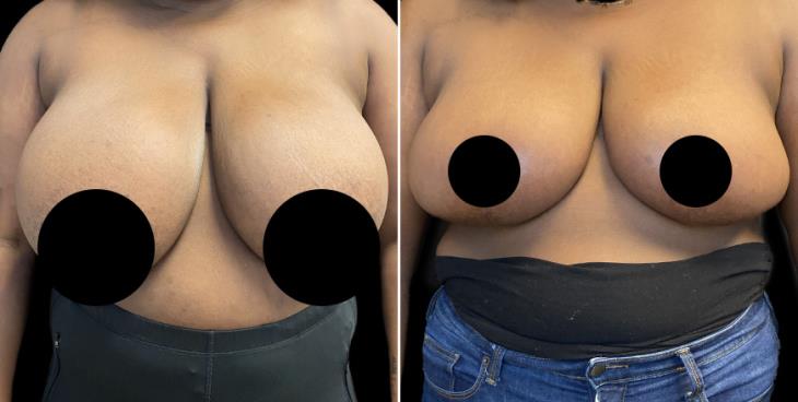 Front View Reduced Breasts GA