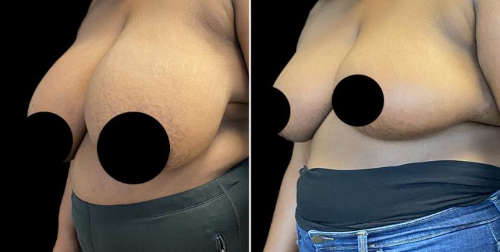 ¾ View Reduced Breasts GA