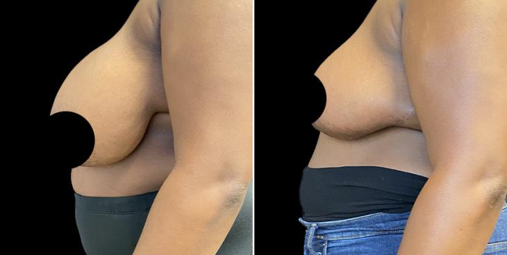 GA Side View Reduced Breasts