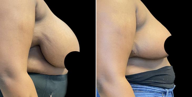 Side View Reduced Breasts GA