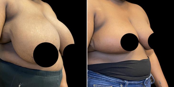 GA ¾ View Reduced Breasts