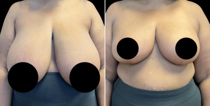 Front View Reduced Breasts Georgia