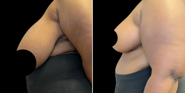 Side View Reduced Breasts Georgia