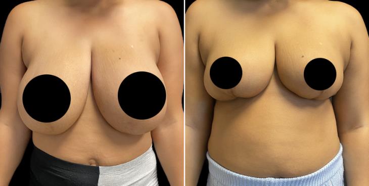 Front View Reduced Breasts Atlanta GA