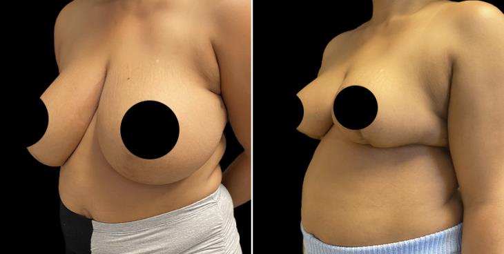 ¾ View Reduced Breasts Atlanta GA
