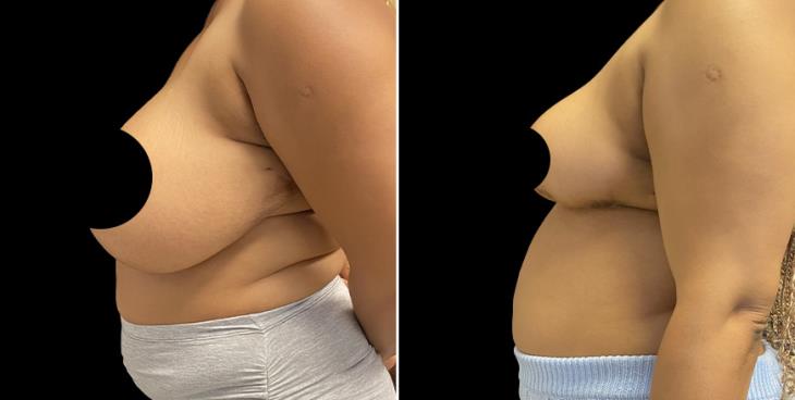 Side View Reduced Breasts Atlanta GA
