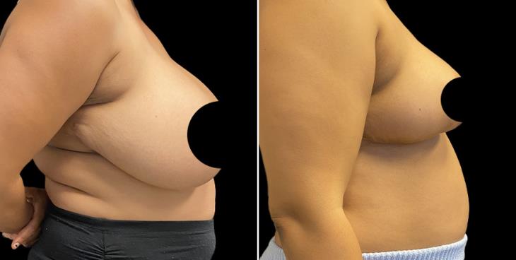 Reduced Breasts Atlanta GA Side View