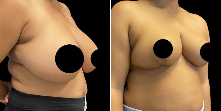 Atlanta GA ¾ View Reduced Breasts