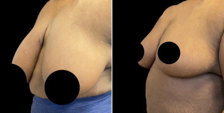 Reduced Breasts Marietta ¾ View