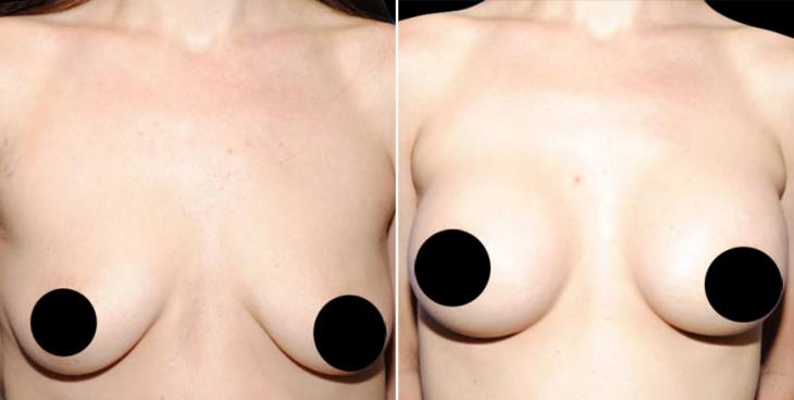 Before And After Breast Augmentation Atlanta Georgia