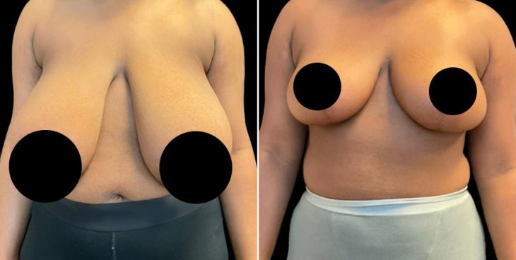 Reduced Breasts Marietta GA Front View
