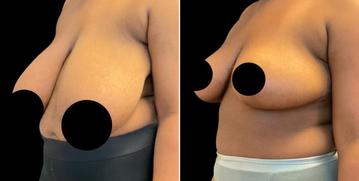 Reduced Breasts Marietta GA ¾ View