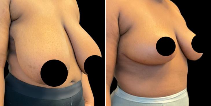 ¾ View Reduced Breasts Marietta GA