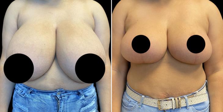 Front View Reduced Breasts Marietta Georgia