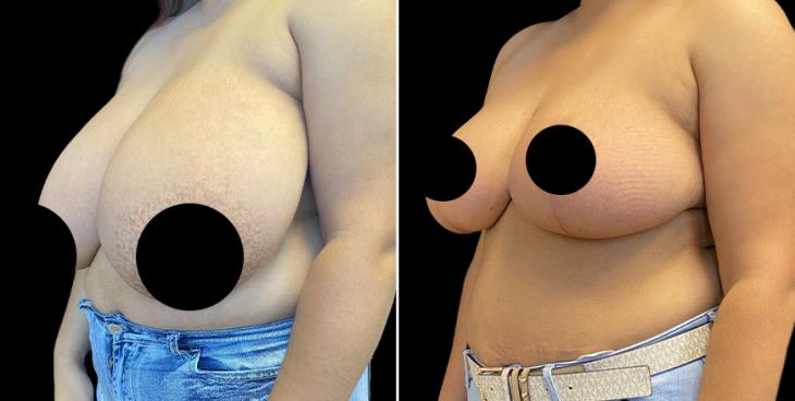 ¾ View Reduced Breasts Marietta Georgia
