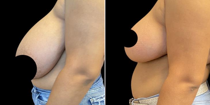 Side View Reduced Breasts Marietta Georgia