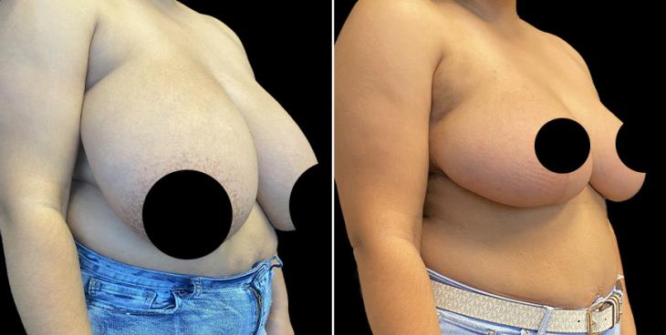 Marietta Georgia ¾ View Reduced Breasts