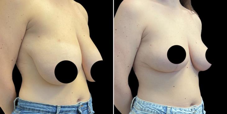 ¾ View Reduced Breasts Cumming GA