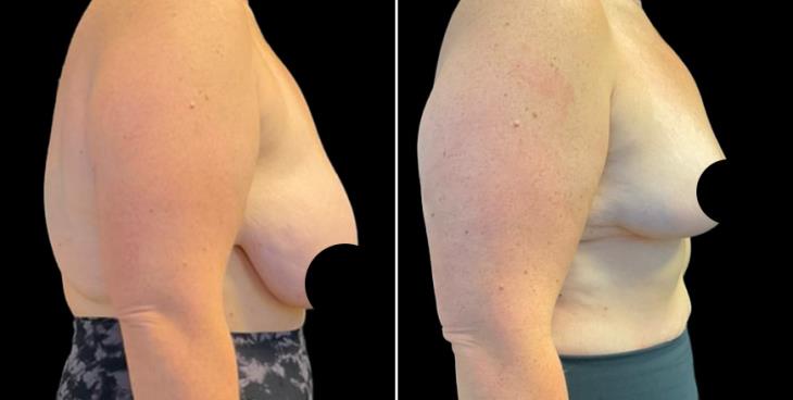 Reduced Breast Size GA