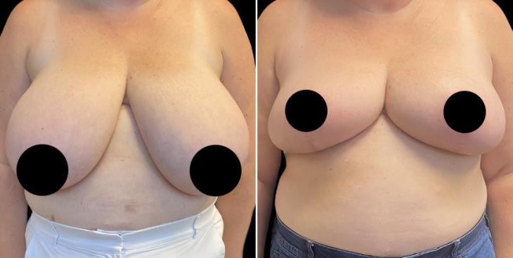 GA Reduced Breast Size