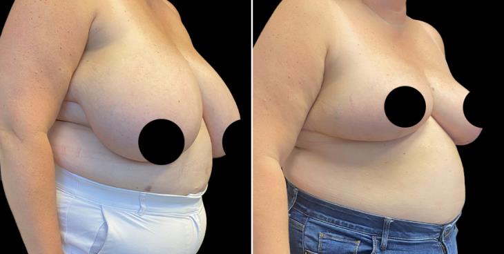 Reduced Breast Size Cumming GA