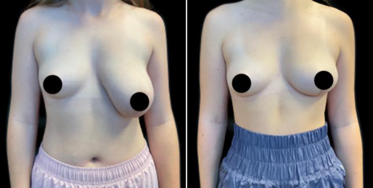 Reduced Breast Size Cumming Georgia