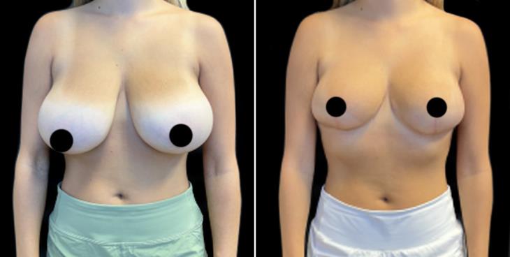 Reduced Breast Size Marietta GA