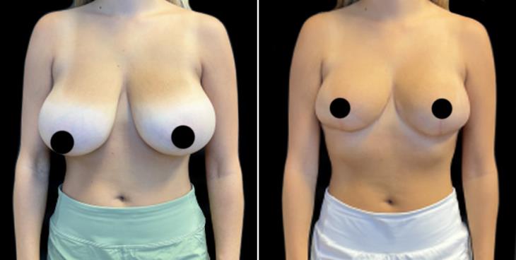 Reduced Breast Size Marietta GA