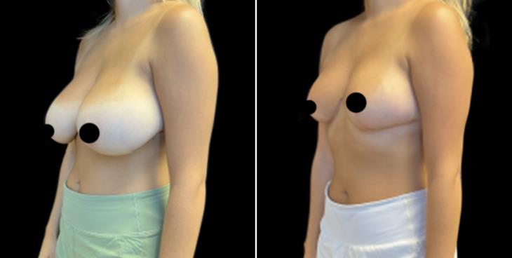 Marietta GA Reduced Breast Size