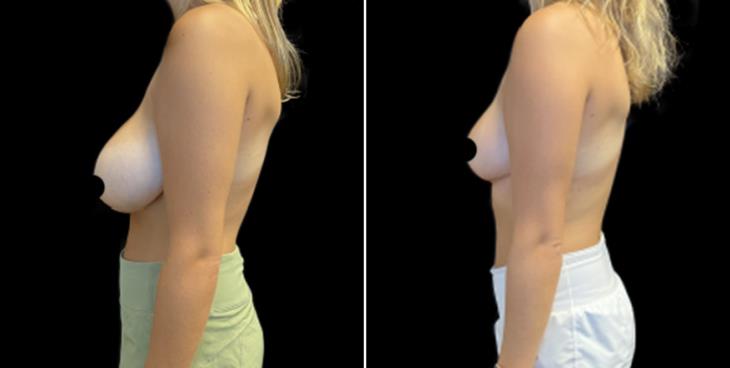 Marietta Georgia Reduced Breast Size