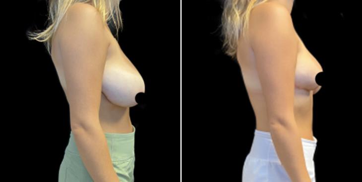 Decreased Breast Size