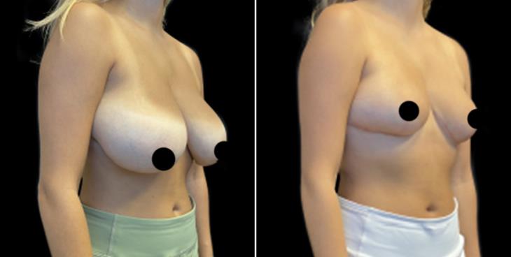 Reduced Breast Size Marietta Georgia