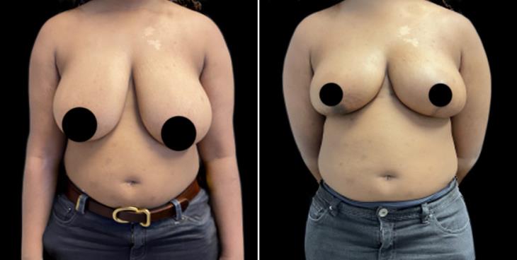 Decreased Breast Size Georgia
