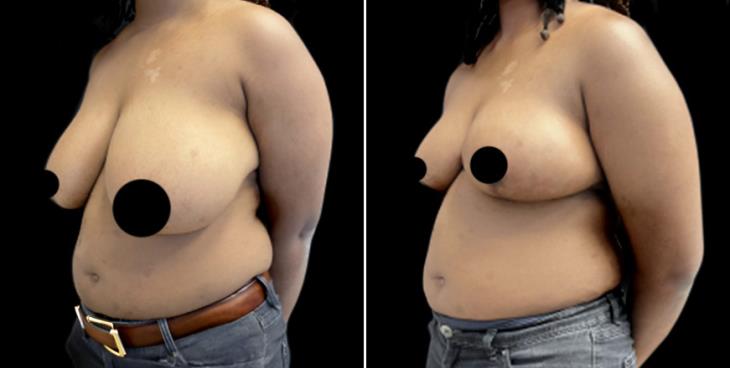 Georgia Decreased Breast Size