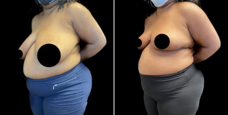 Decreased Breast Size Atlanta GA